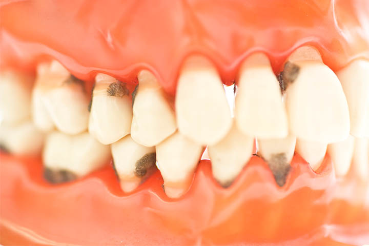 DiÅŸler Neden Ã‡Ã¼rÃ¼r?